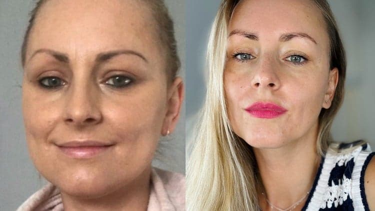 NOTOX Natural Forehead Smoothing Method - Free Udemy Course